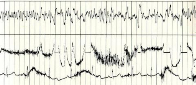 Ann Druyan'ın 3 Haziran 1977'de kaydedilen beyin dalgalarından bir örnek.