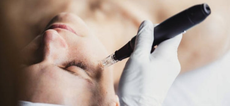Book Now! Exclusive Mesotherapy Discount in Riyadh