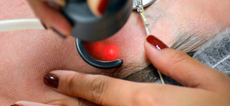 Fractional Laser Treatment in Riyadh: A Safe and Effective Solution