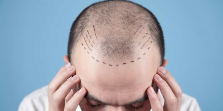 Kök Hücreli Saç Ekimi Etkili Bir tedavi mi?