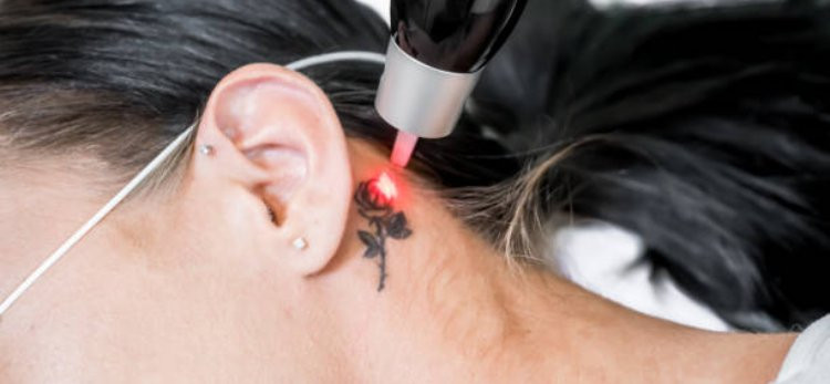 Laser Tattoo Removal for Changing the Appearance of Regretted Tattoos