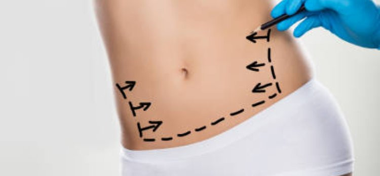 Liposuction for Creating More Refined and Harmonious Body Contours