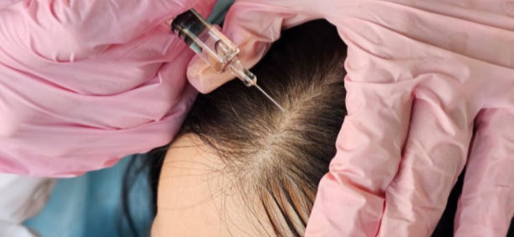 PRP Hair Treatment for Reviving the Appearance of Lifeless Hair