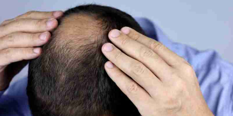 Saç Dökülmesine İyi Gelen Tedaviler