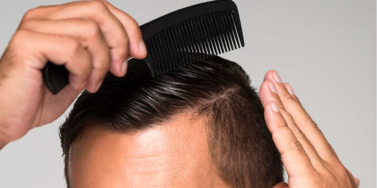 Seyrek Saç Sorununa Etkili Çözüm: Saç Ekimi