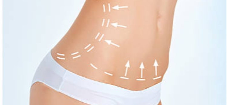 Understanding the Limits of Liposuction for Body Shaping