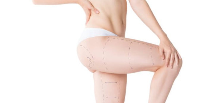What Factors Affect Liposuction Results?