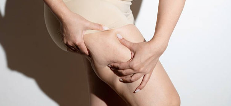 What Results Can You Expect After Lipedema Treatment?
