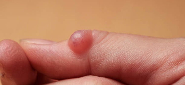 What Should You Avoid After a Wart Removal Procedure?